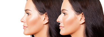 Rhinoplastie