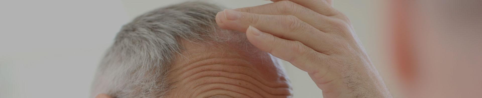 Greffe de Cheveux