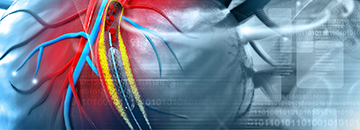 Angioplastie Par Ballonnet et Placement de Stent