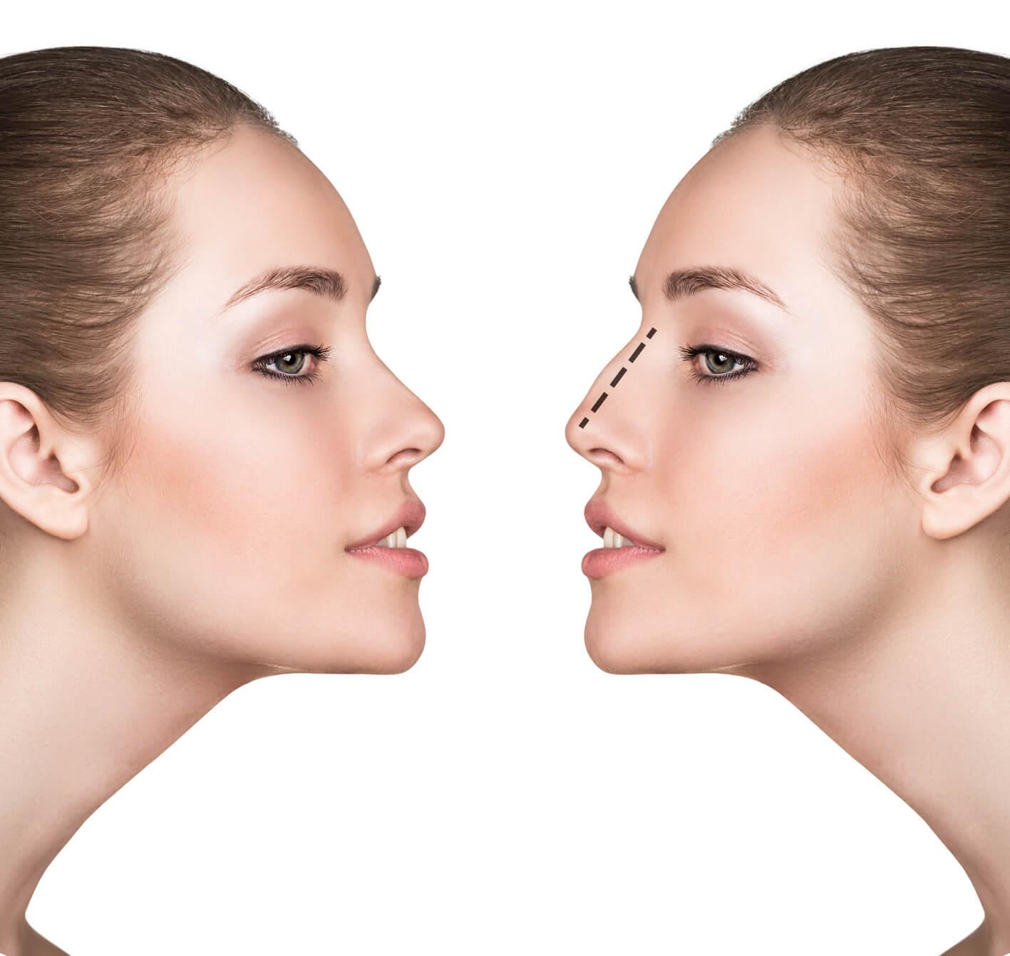 Rhinoplastie